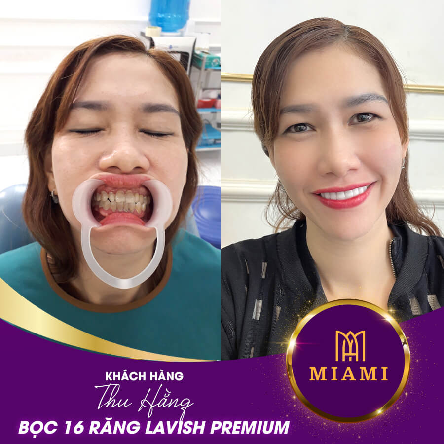 Bọc răng sứ tại MIAMI - Phương pháp khắc phục răng không đều sau 48H